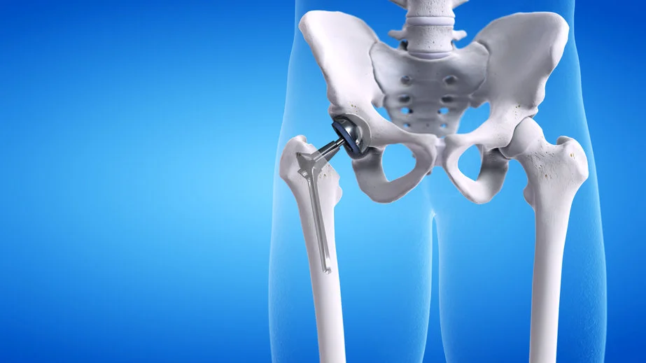 Doctor explaining hip replacement
