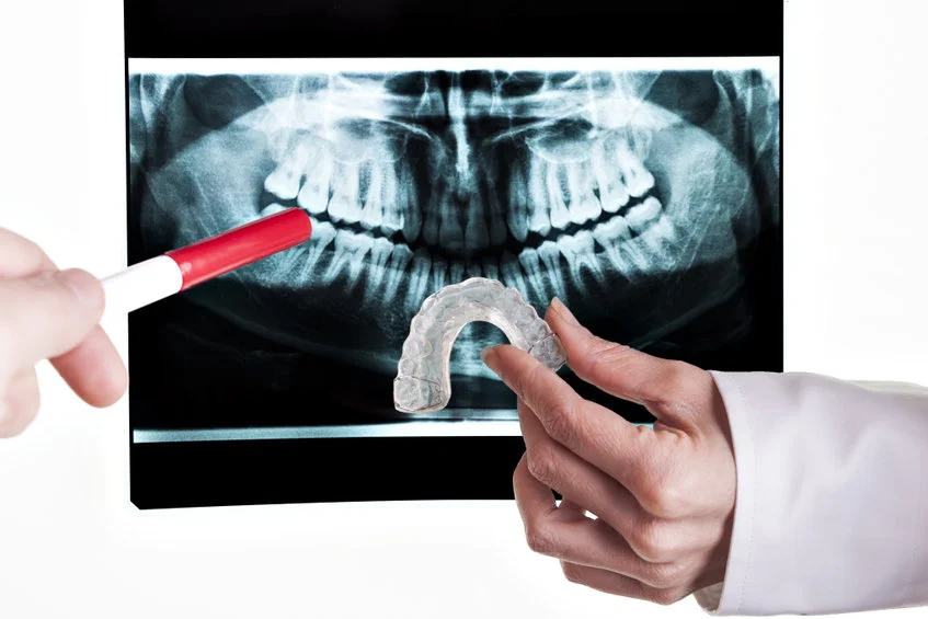 Teeth grinding bruxism causes symptoms