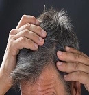 Hair Loss