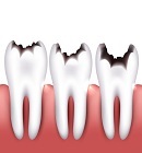 Tooth decay