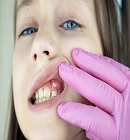 Dental Abscess