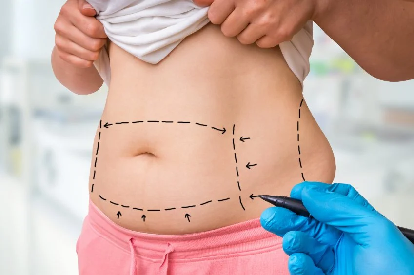 Tummy tuck abdominoplasty cosmetic surgery