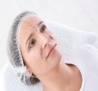 Nose reshaping (rhinoplasty)