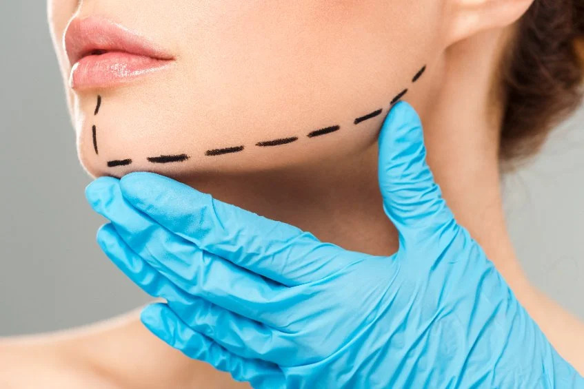 Facelift rhytidectomy cosmetic surgery overview