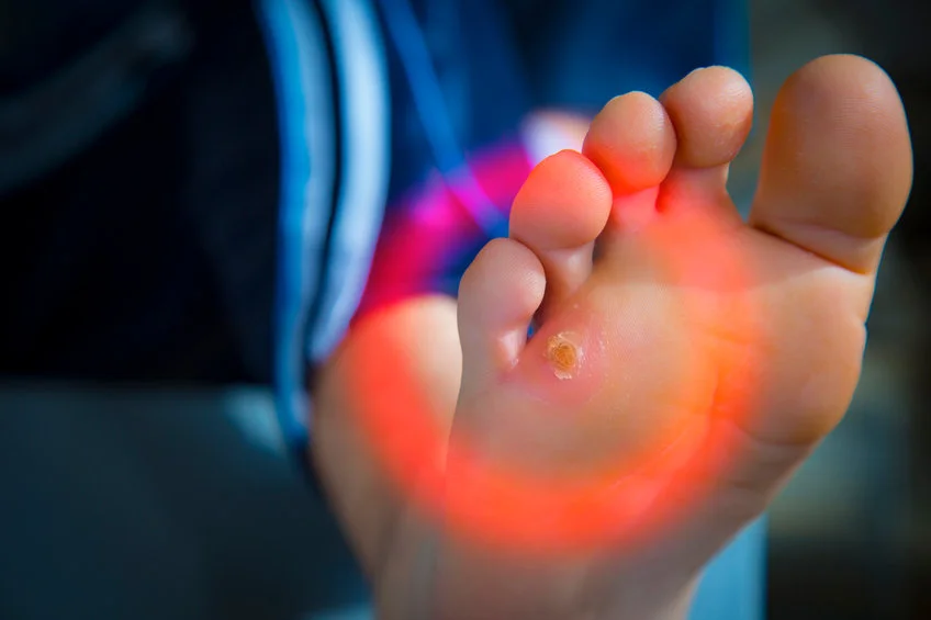 Warts verrucas symptoms pharmacy treatment